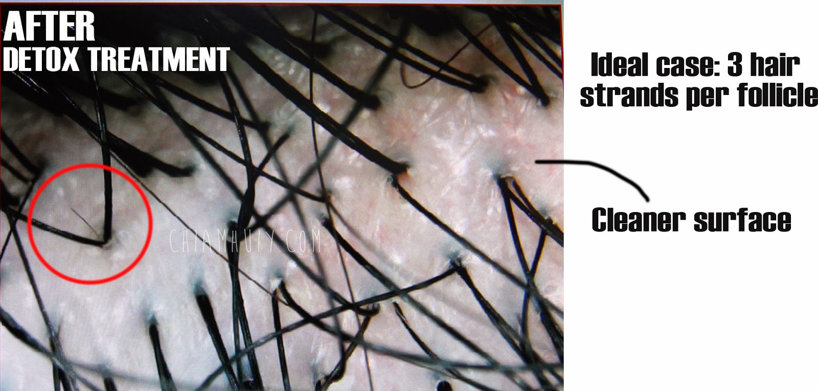 Hair Loss Treatment - Detox Treatment @ Phyto Hair Science - Celine ...